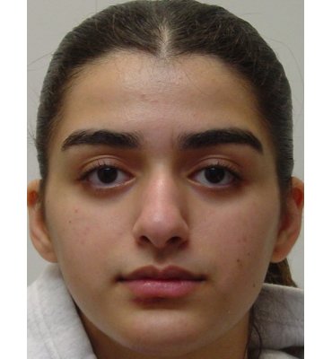 Revision Rhinoplasty